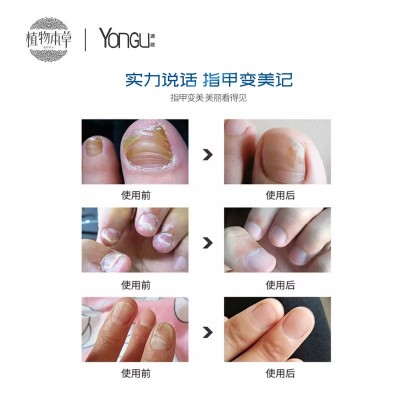 YONGU源顾指甲生物液植物草本指甲修护液一笔亮指甲营养液袋装图4